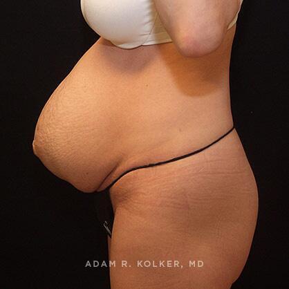 Tummy Tuck Before Image Patient 17 Side View