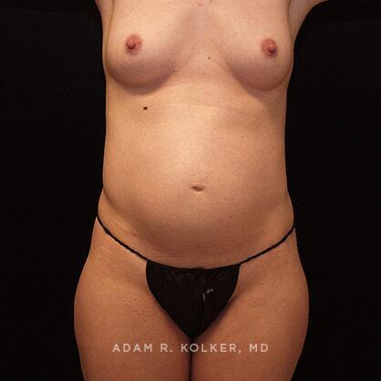 Tummy Tuck Before Image Patient 18 Front View