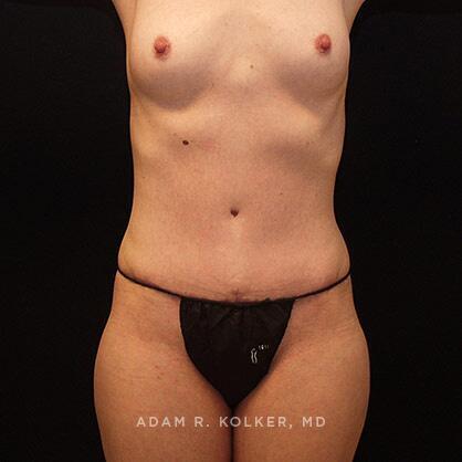 Tummy Tuck After Image Patient 18 Front View