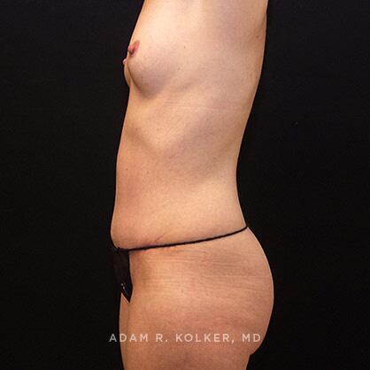 Tummy Tuck After Image Patient 18 Side View