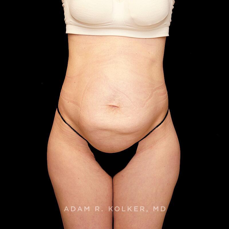 Tummy Tuck Before Image Patient 19 Front View