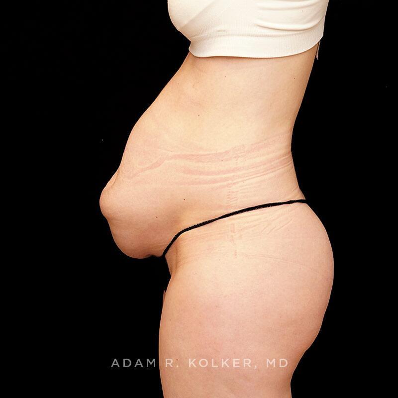 Tummy Tuck Before Image Patient 19 Side View