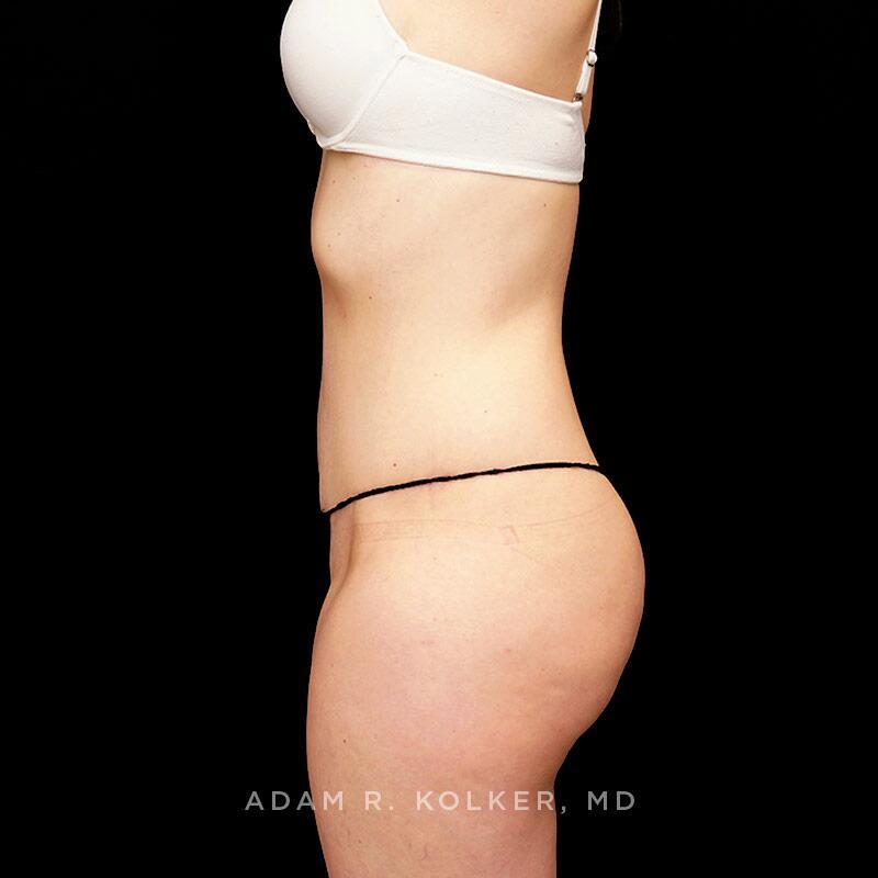 Tummy Tuck After Image Patient 19 Side View