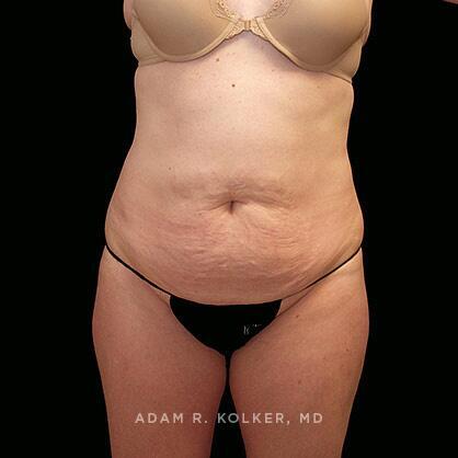 Tummy Tuck Before Image Patient 21 Front View