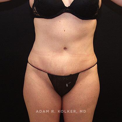 Tummy Tuck After Image Patient 21 Front View