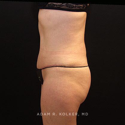 Tummy Tuck After Image Patient 21 Side View