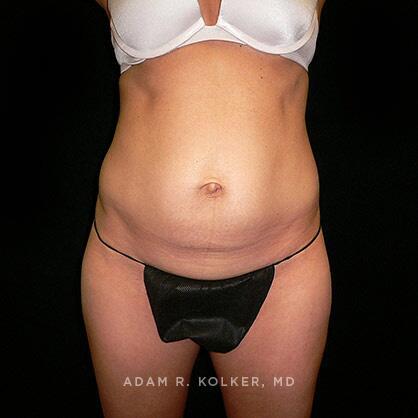 Tummy Tuck Before Image Patient 22 Front View