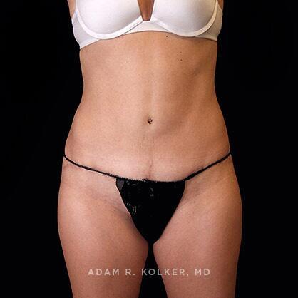 Tummy Tuck After Image Patient 22 Front View