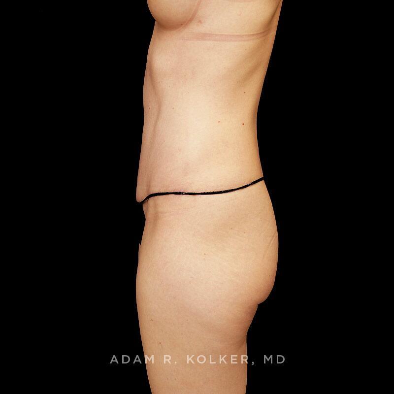 Tummy Tuck After Image Patient 23 Side View