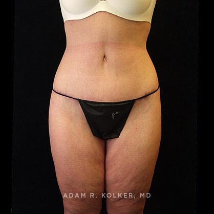 Tummy Tuck After Image Patient 24 Front View