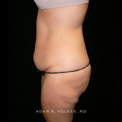 Tummy Tuck Before Image Patient 24 Side View