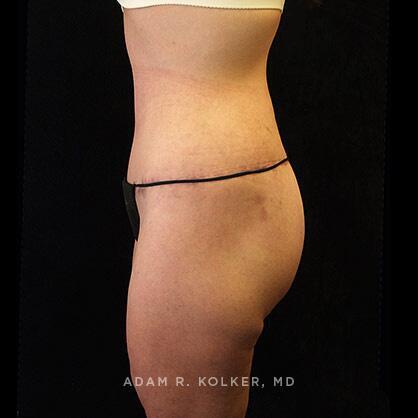 Tummy Tuck After Image Patient 24 Side View