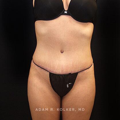Tummy Tuck After Image Patient 28 Front View