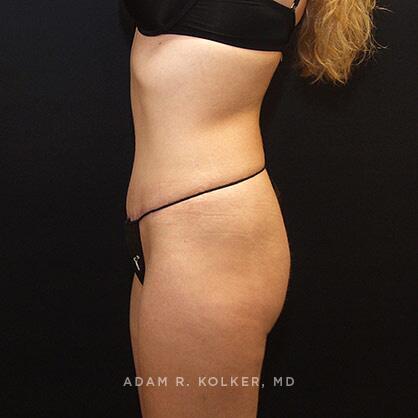 Tummy Tuck After Image Patient 28 Side View