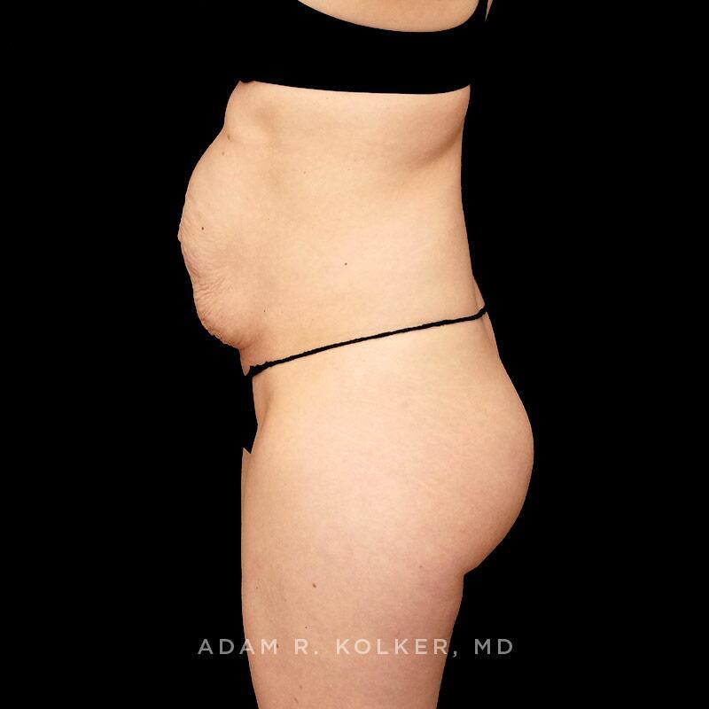 Tummy Tuck Before Image Patient 29 Side View