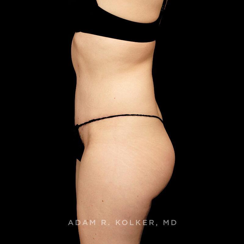 Tummy Tuck After Image Patient 29 Side View