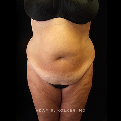 Tummy Tuck Before Image Patient 30 Front View