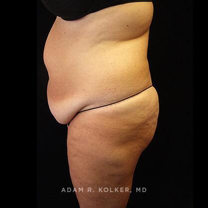 Tummy Tuck Before Image Patient 30 Side View
