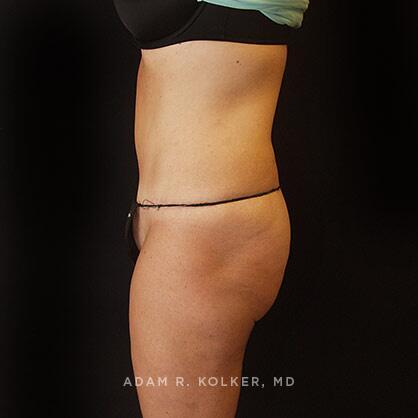 Tummy Tuck After Image Patient 30 Side View