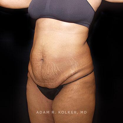 Tummy Tuck Before and After Image