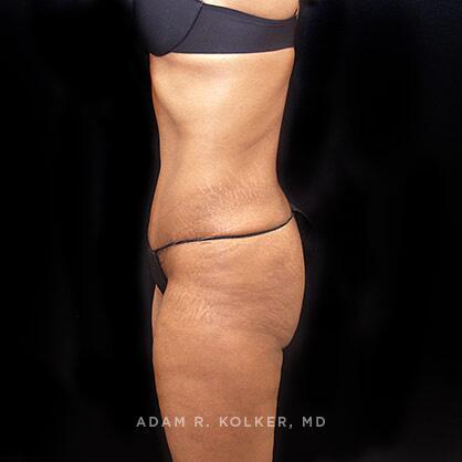 Tummy Tuck After Image Patient 31 Side View