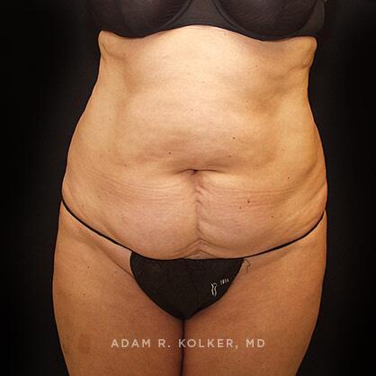 Tummy Tuck Before Image Patient 33 Front View