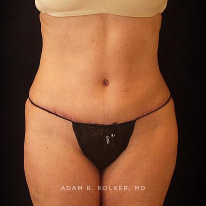 Tummy Tuck After Image Patient 33 Front View
