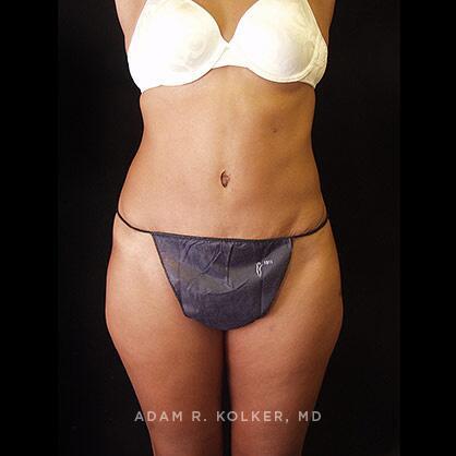 Tummy Tuck After Image Patient 34 Front View