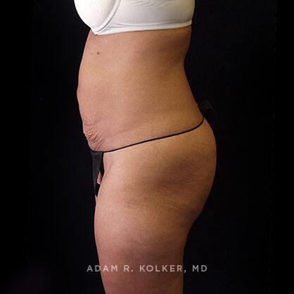 Tummy Tuck Before Image Patient 34 Side View