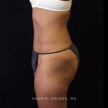 Tummy Tuck After Image Patient 34 Side View