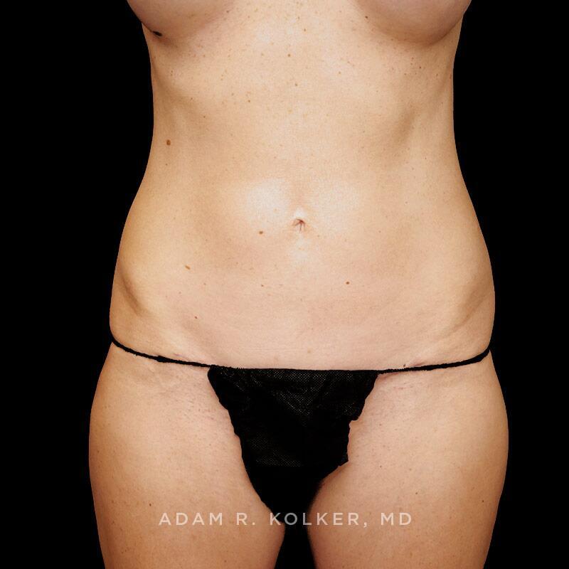 Tummy Tuck After Image Patient 35 Front View