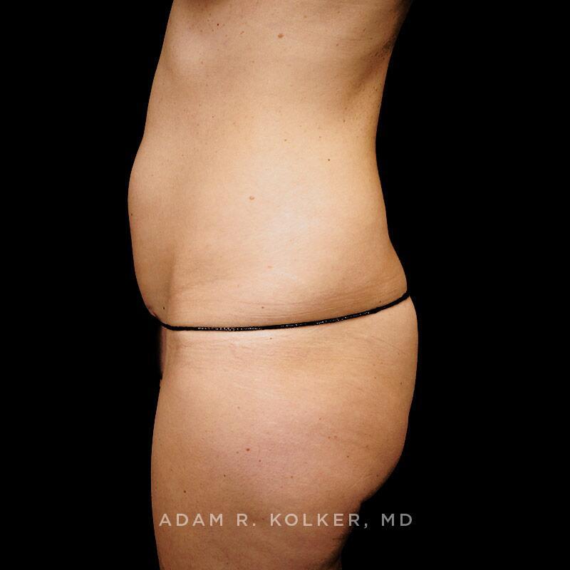 Tummy Tuck Before Image Patient 35 Side View