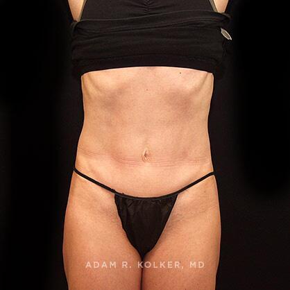 Tummy Tuck After Image Patient 37 Front View