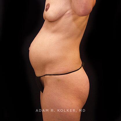 Tummy Tuck Before Image Patient 38 Side View