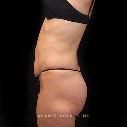 Tummy Tuck After Image Patient 38 Side View