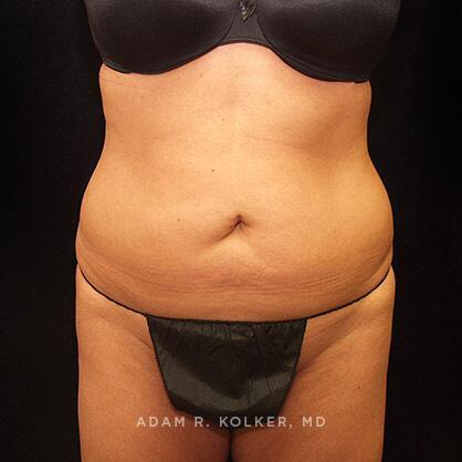 Tummy Tuck Before Image Patient 39 Front View