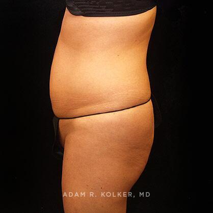 Tummy Tuck Before Image Patient 39 Side View