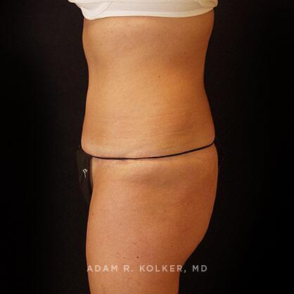 Tummy Tuck After Image Patient 39 Side View