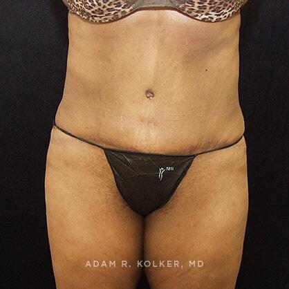 Tummy Tuck After Image Patient 40 Front View