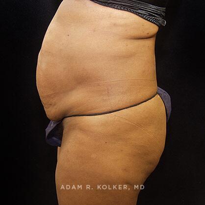 Tummy Tuck Before Image Patient 40 Side View