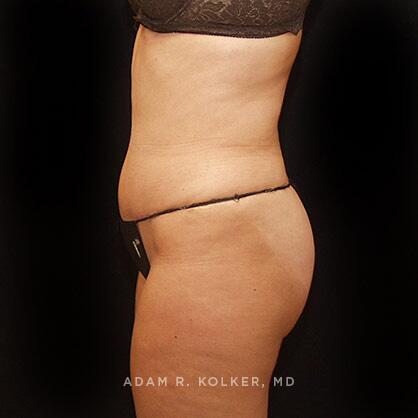 Tummy Tuck After Image Patient 41 Side View