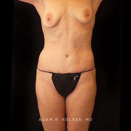 Tummy Tuck After Image Patient 42 Front View