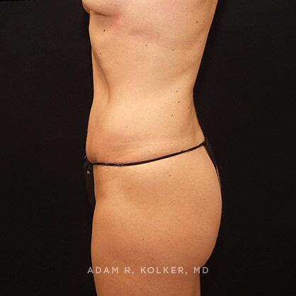 Tummy Tuck After Image Patient 42 Side View