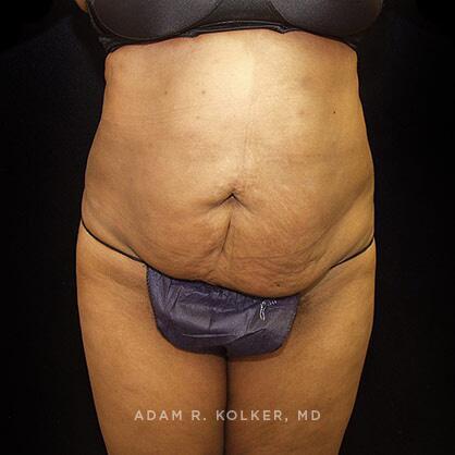 Tummy Tuck Before Image Patient 43 Front View