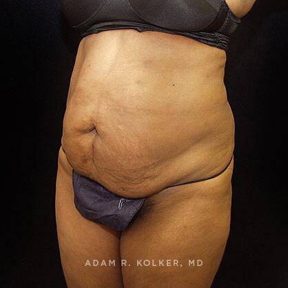 Tummy Tuck Before Image Patient 43 Oblique View