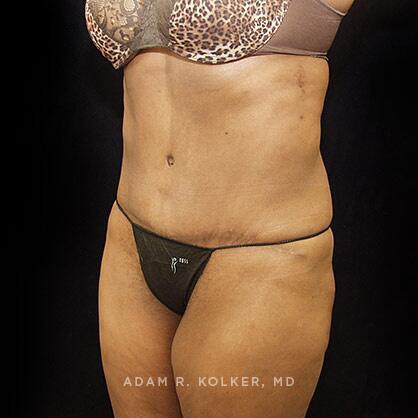 Tummy Tuck After Image Patient 43 Oblique View