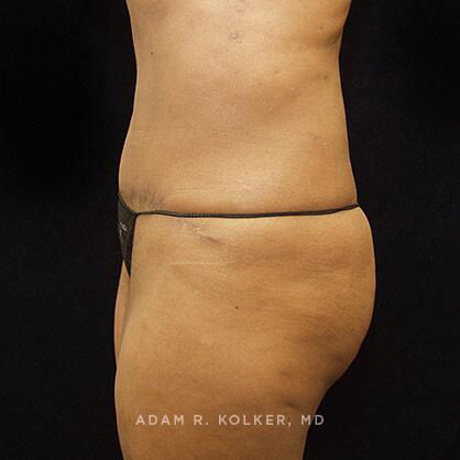 Tummy Tuck After Image Patient 43 Side View