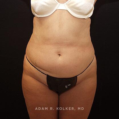 Tummy Tuck Before Image Patient 44 Front View