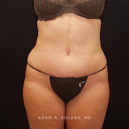 Tummy Tuck After Image Patient 44 Front View