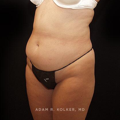 Tummy Tuck Before Image Patient 44 Oblique View